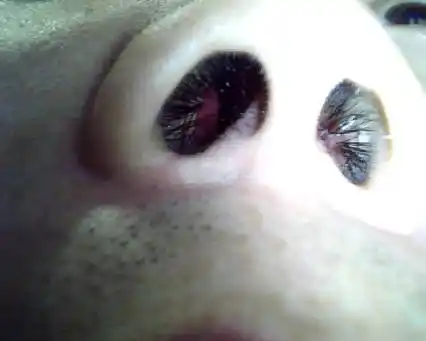 我鼻孔里面有个红包,今天照镜子时发现的.