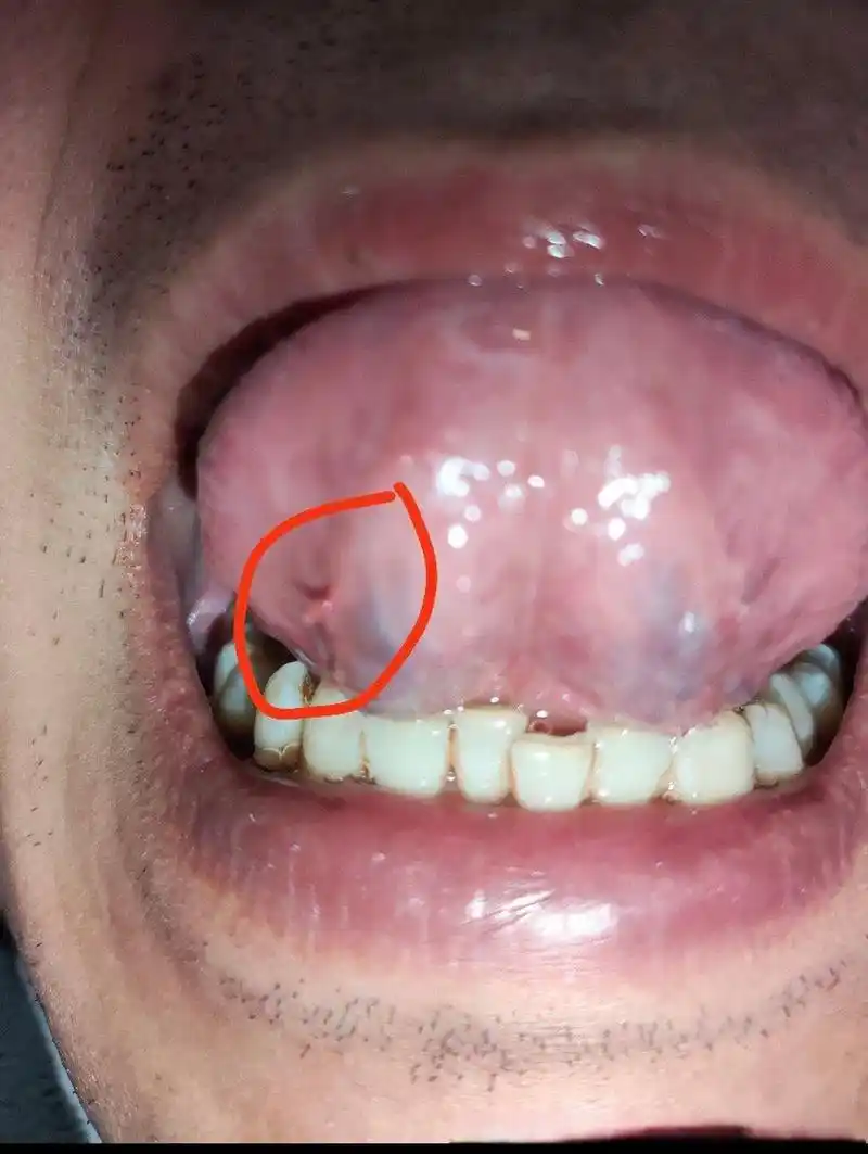 #老高老高了的皮肤科#高主任口腔舌头下面,正常吗? #帮她问问大家#