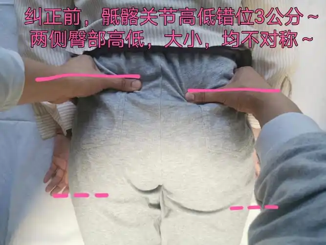 有脊柱侧弯,导致有高低肩和,肩胛骨高低错位问题,肋骨外翻和假胯宽较