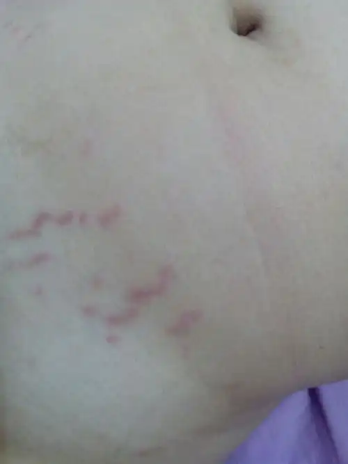 肚子上出现这种纹,是怎么回事?女生!