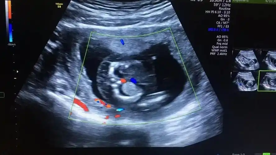 粗心孕妈14周才做首次产检仁爱医院及时筛查出胎儿严重畸形