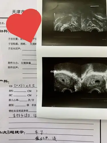 这孕囊是个长方体的