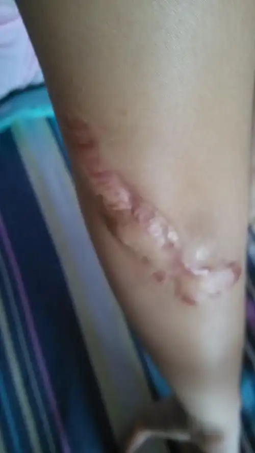 露珠右胳膊肘弯曲处12厘米的手术开口,因疤痕体质所以愈合后增