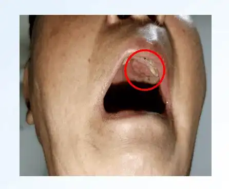 口腔增强ct(2020-10-22)口腔活检病理:左上颚软组织肿块穿刺活检术