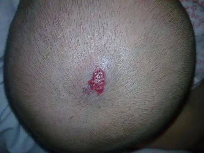 我的宝宝头顶上长了血管瘤,有图,请帮我看看该怎样治疗.