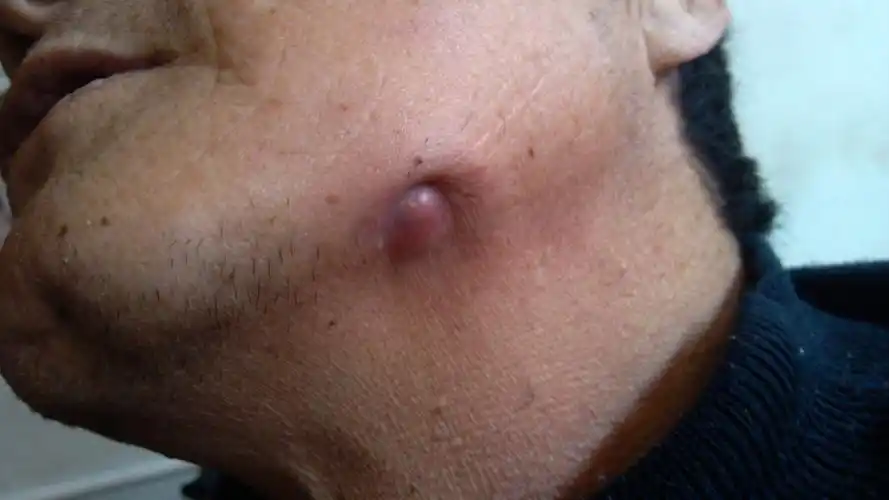 左下颚肿物伴脓性分泌物