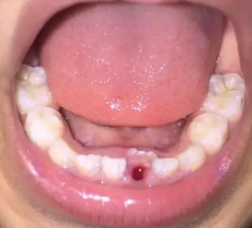 一例乳牙拔除的启示牙医圈每日病例分享