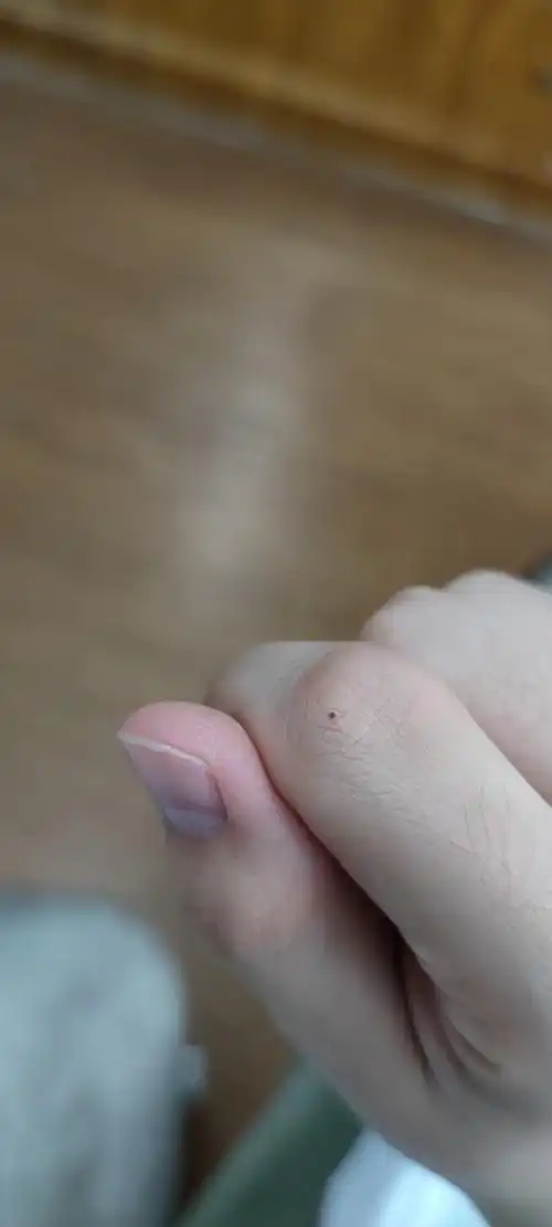 手指上突然出现了个黑点