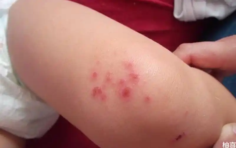 图解儿童尿布疹的症状3种类型的病情表现都不一样