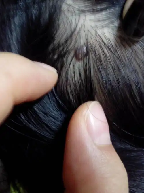 这个东西长很久了,不痛不痒,我一直觉得是痣,头皮上好像还有两三颗,这