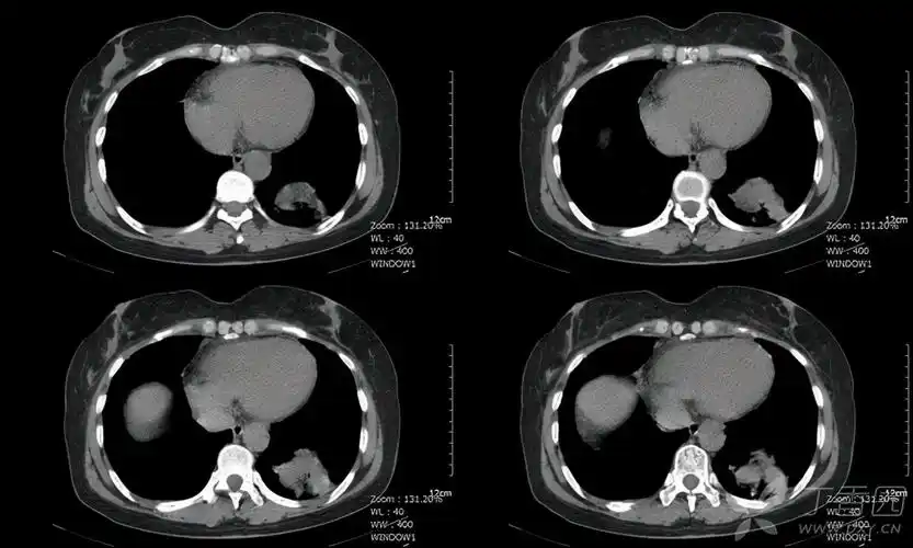 ct增强多少钱做ct对人的危害有多大