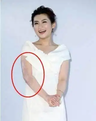 当年selina全身54%严重烧伤,近八成是三度烧伤,主要分布在背部和四肢.