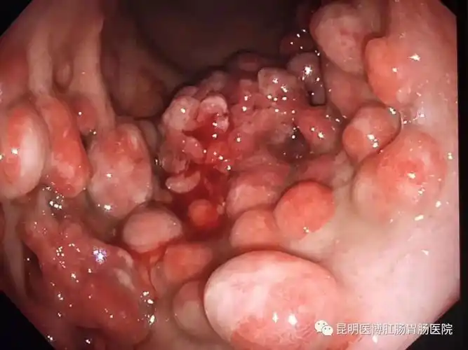 肠息肉6年变成癌医生提醒肠镜要做息肉要切