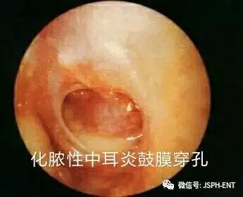 耳朵疾病常见的几种耳内镜照片