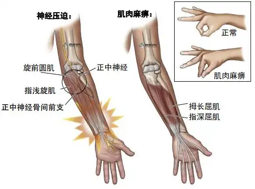 疼痛解剖学前臂骨间综合征
