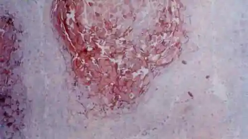 形态如丘疹状,乳头状,菜花状,鸡冠状,性质细嫩,顶端稍尖,无痛痒感