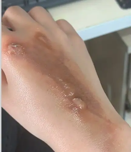 您好我手被电器烫伤了这种情况需不需要去医院目前是用碘伏消毒