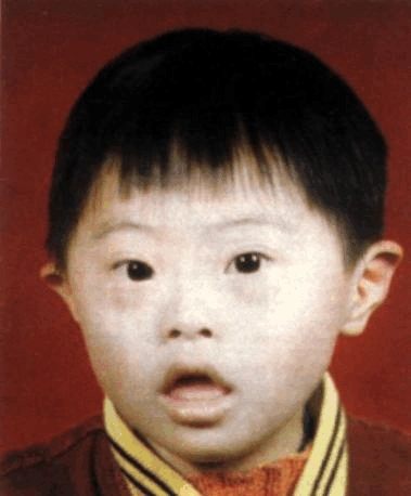 唐氏综合征无创产前基因检测