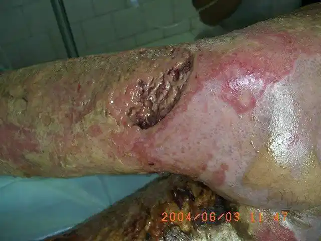 四川什邡川磷烧烫伤专科医院救治的一例特大面积烧伤患者