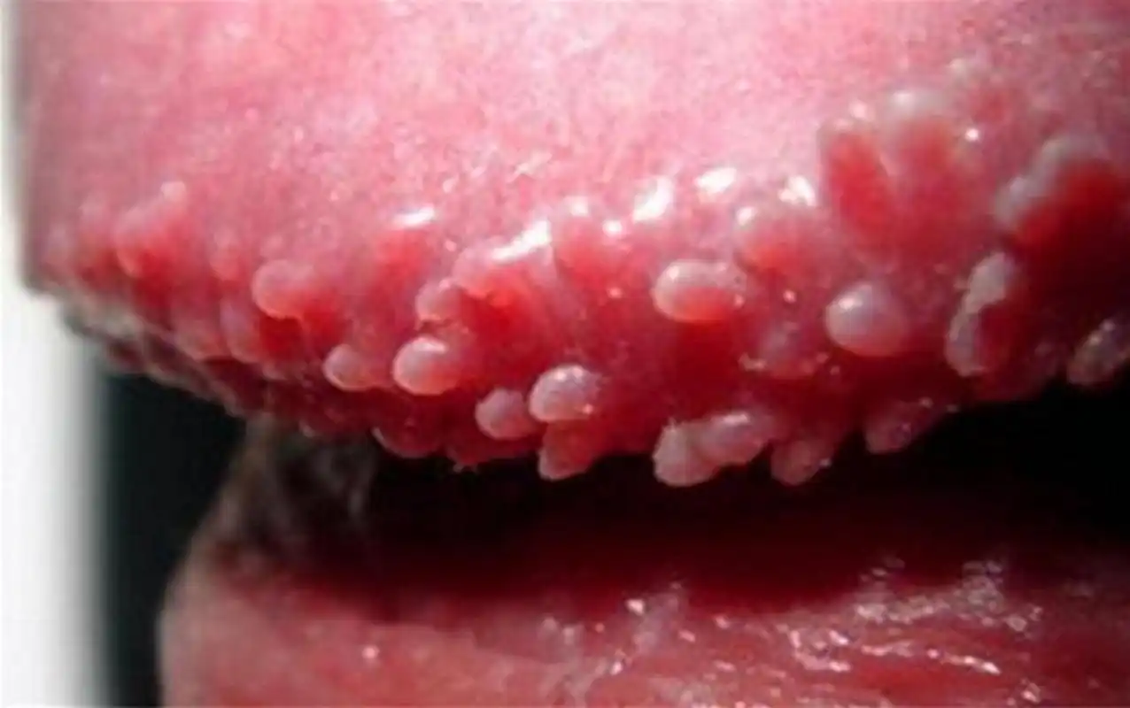 怎么判断是不是感染了尖锐湿疣?