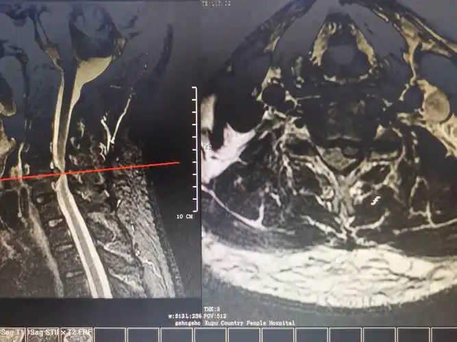 溆浦县人民医院骨一科成功完成多例颈椎病的手术治疗!
