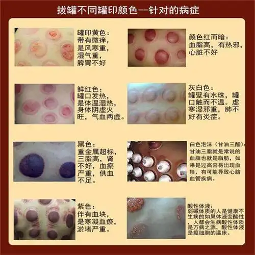拔罐后湿气重图片 拔罐后的十大注意事项