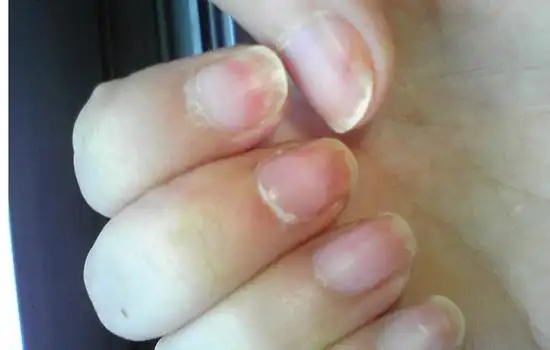 灰指甲如何防传染