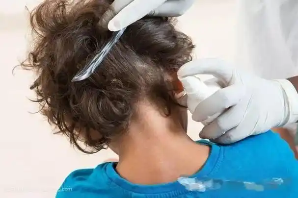 女儿头上长了许多虱子,宝妈用热夹板把头发烫了烫,结果很舒适