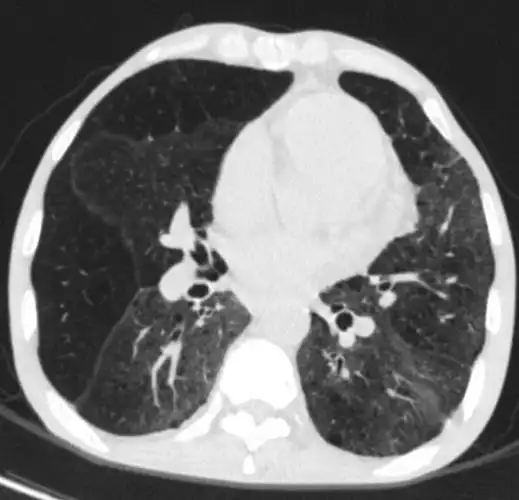 肺良性磨玻璃ct表现——容易误诊为肺癌的磨玻璃结节