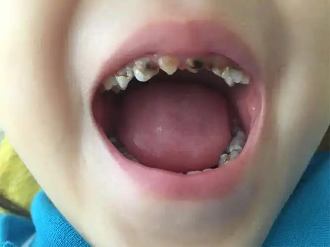 老师,老师,我的牙齿变黑了