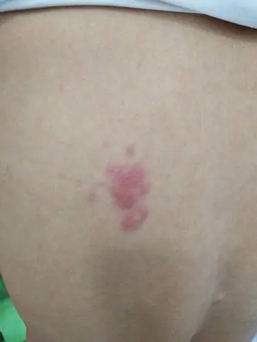 皮肤长了一块红点,看了外面的民间医生说是缠身龙