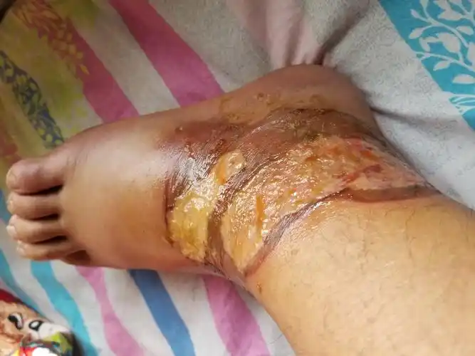 脚被热水烫伤了已经7天了 昨天刚出院 今天早晨起床发现脚背肿了起来