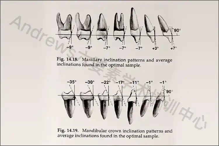 冠倾斜:牙冠长轴的龈方部分在切缘或牙尖的远中方向.