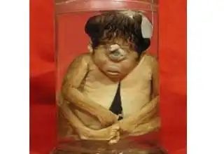 俄罗斯出生一独眼女婴 鼻子似阴道长在前额(图)