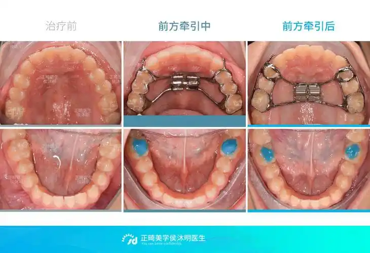 青少年骨性地包天矫正案例_牙颌畸形 - 好大夫在线