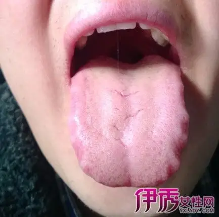 【图】舌头边缘呈锯齿状怎么回事 因脾虚寒湿壅盛而成