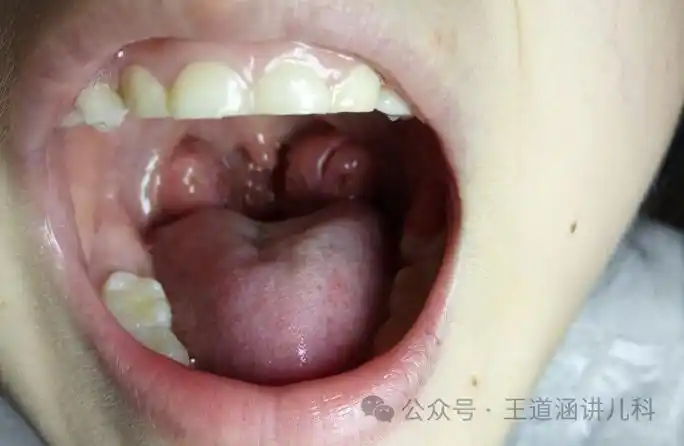 说了800遍了孩子腺样体肥大就是被屎堵住了而已