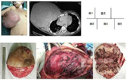 原发性乳腺纤维肉瘤1例及病例讨论