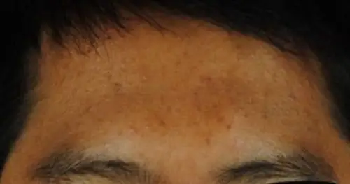 这是肝病面容皮肤图片