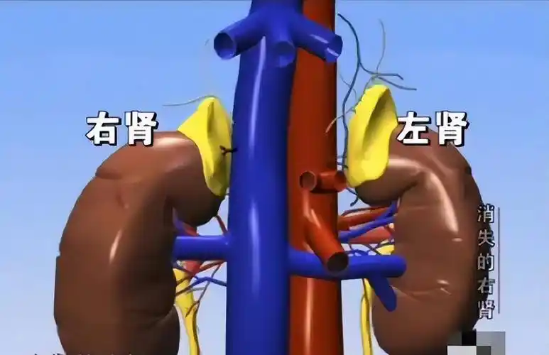 湖北老汉检查发现右肾不见,想起两年前手术:医生拿去卖钱了_万润平_县