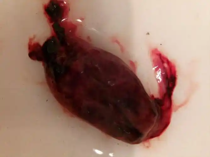 我药流已经第六天了,这排出来的是什么?