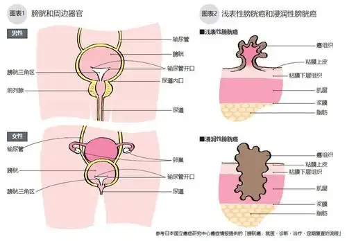 日本专家谈肿瘤膀胱癌