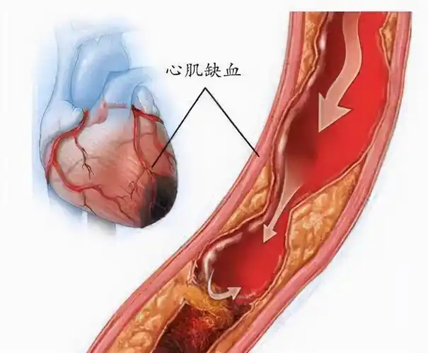年轻人心肌缺血的发病率高不高?