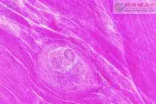 人食入活旋毛虫囊包后,囊包经胃液消化,在十二指肠释出幼虫,约经5