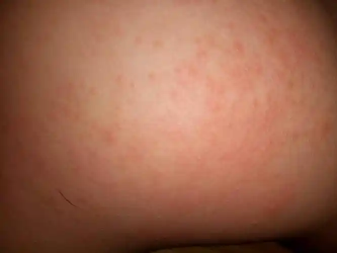 有谁知道,我家宝宝这屁股上长的是痱子.还是湿疹