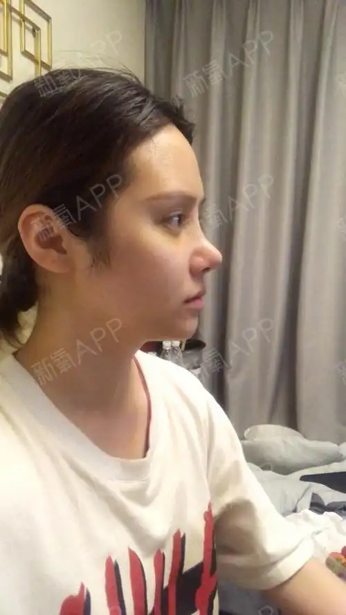 前置侧面鼻子很丑鼻头朝天鼻背低山根有点肿不晓得消下_圈子-新氧美容