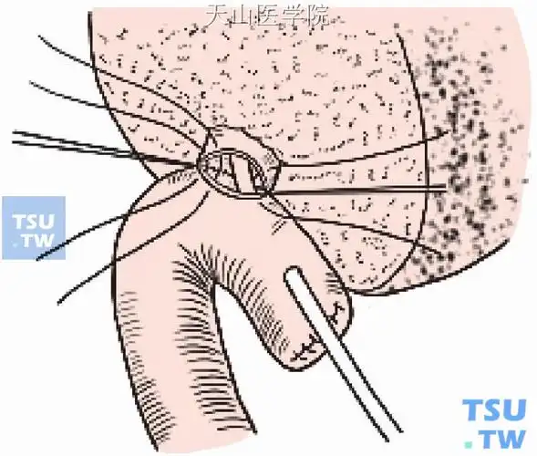 肝管空肠roux-en-y吻合 左半肝切除术 【普通外科手术彩色图解】