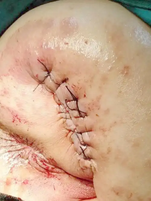 隆回中医医院外科采用外科清创结合vsd引流治疗压疮疗效显著