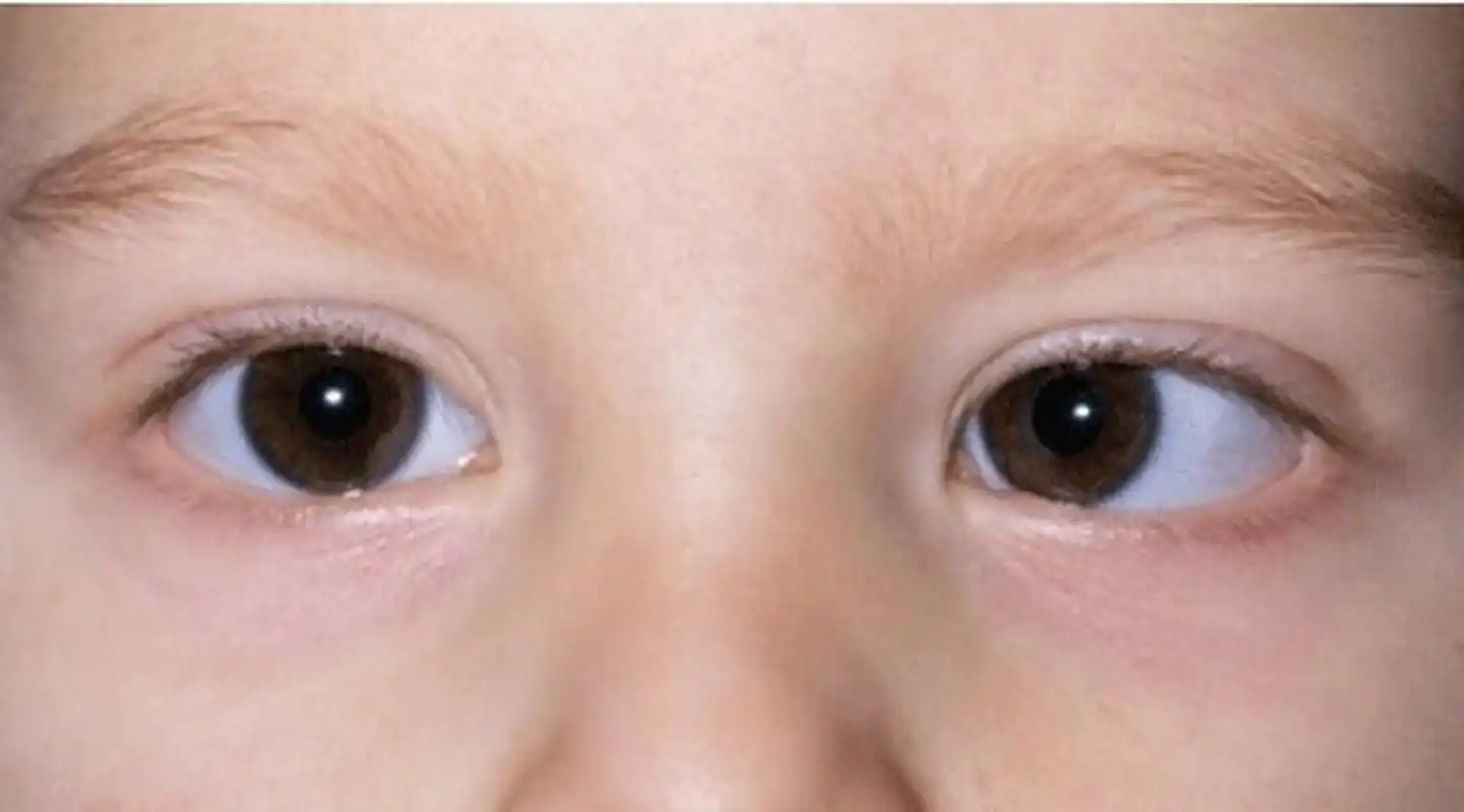 对于家长来说,发现孩子患有先天性斜视可能会令人担忧,但以下是一些