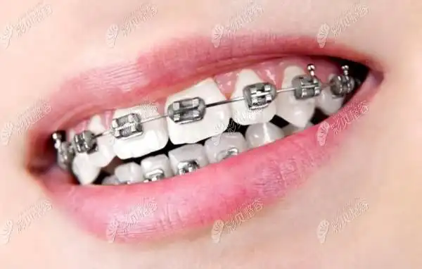 成年人地包天 牙齿拥挤矫正前后对比照,嘉兴金铂利口腔做的 - 整形日